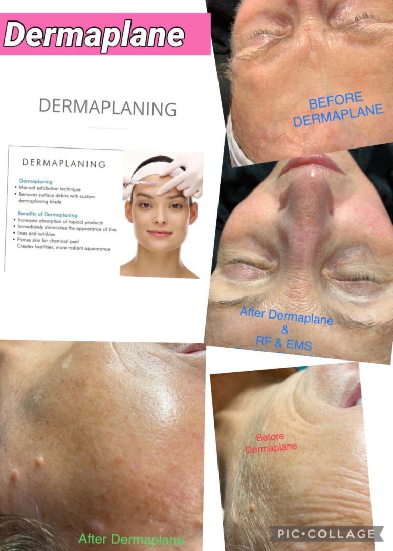 B & A Dermaplane