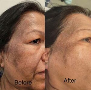 DermaplanePro Before & After